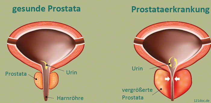 Cialis bei prostatabeschwerden